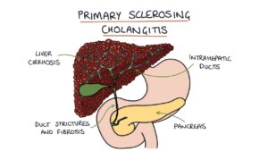 Πρωτοπαθής σκληρυντική χολαγγειίτιδα