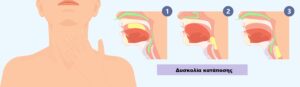 Δυσκολία κατάποσης στο γαστρεντερικό σωλήνα