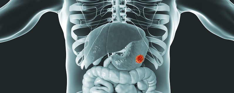 Τρισδιάστατο ιατρικό μοντέλο με καρκίνο του στομάχου