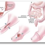 Σχεδιάγραμμα με τη νόσο του Crohn