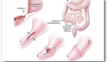 Σχεδιάγραμμα με τη νόσο του Crohn