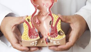 Ιατρικό μοντέλο με ραγάδες πρωκτού